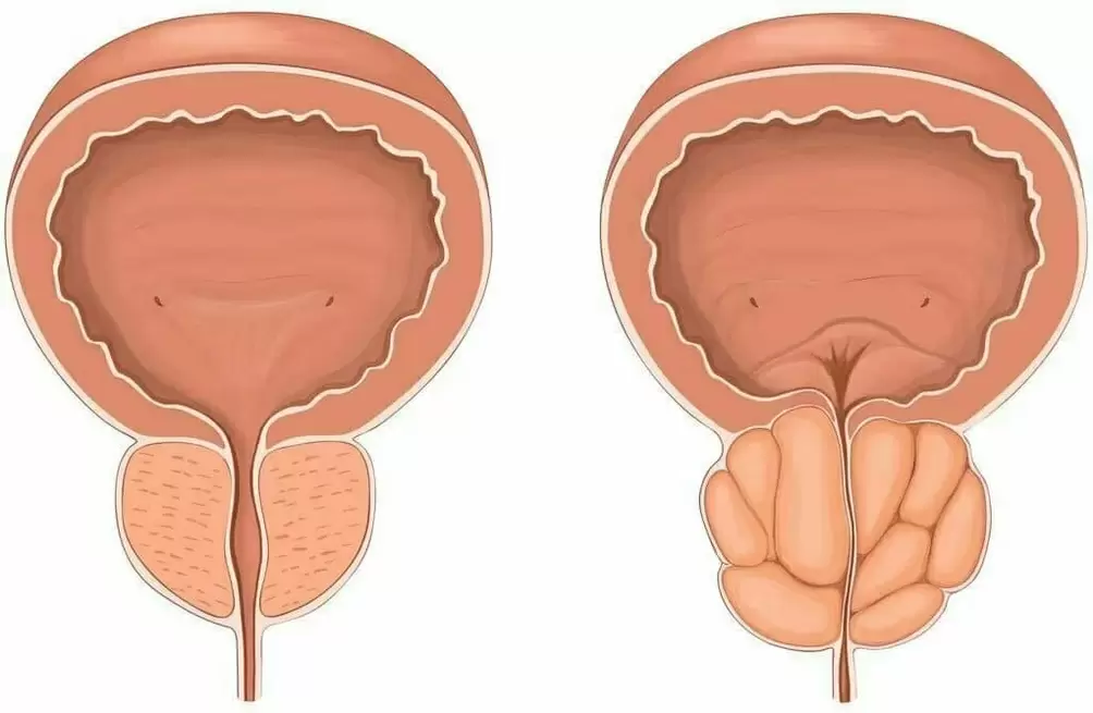 normali prostata ir serganti prostata