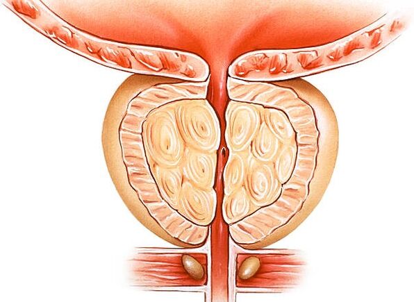 uždegusi prostatos iliustracija